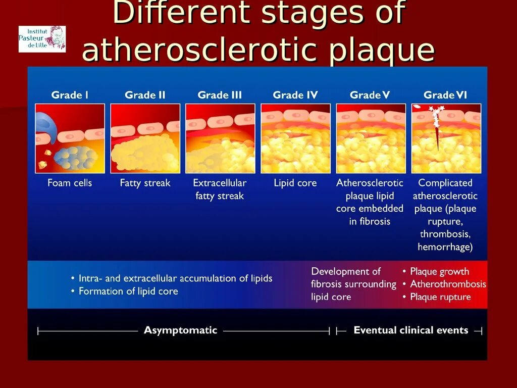 Стадии развития атеросклеротической бляшки. Atherosclerotic Plaque formation mechanisms. Morphology of atherosclerotic Plaque,. Different stages