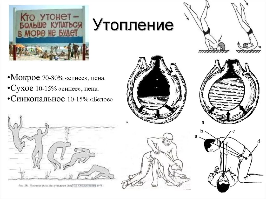 Истинное и синкопальное утопление. Истинное синее утопление. Утопление синкопальное утопление.