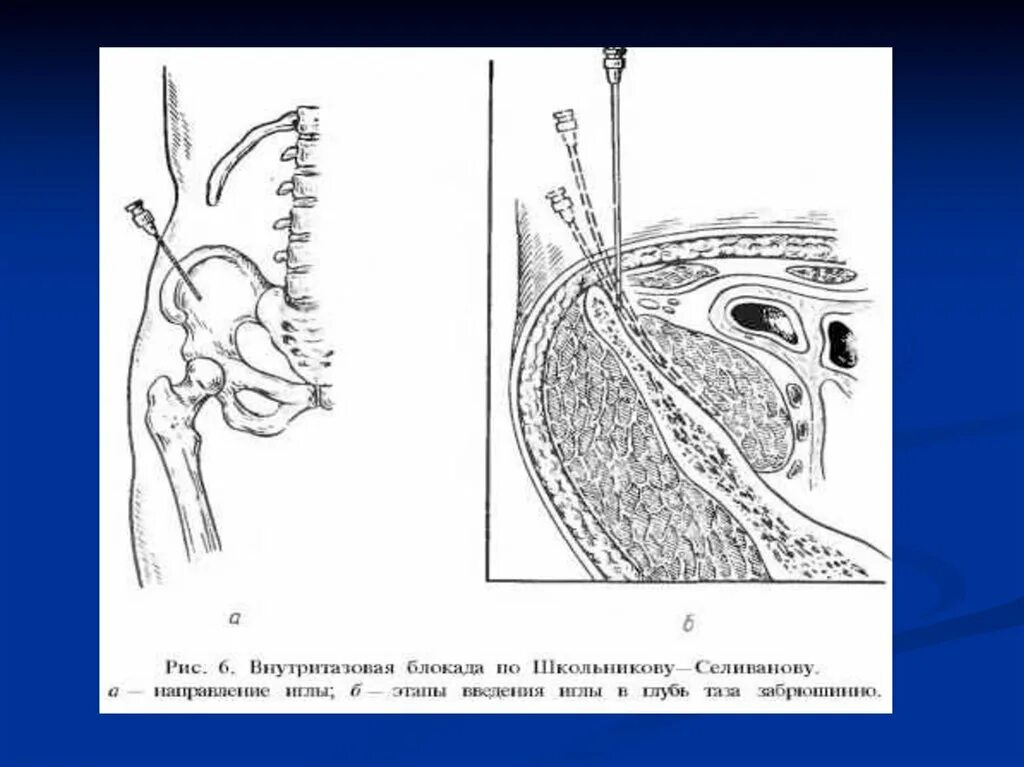 Новокаиновая блокада по Школьникову. Внутритазовая блокада по Школьникову. Школьникову Селиванову блокада. Внутритазовая новокаиновая блокада. Школьникова селиванова