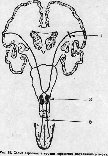 Поражение подъязычного нерва. Поражение подъязычного нерва схема. Подъязычный нерв схема пути. Центральный и периферический паралич подъязычного нерва. Ход подъязычного нерва схема.