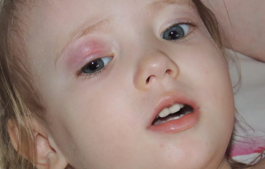 ячмень ребенок 4 года