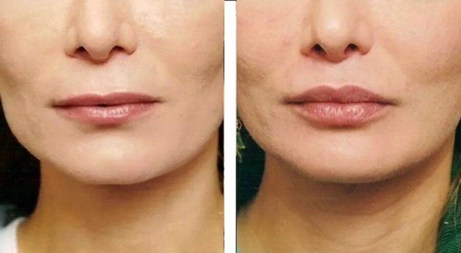 Липофилинг верхней губы. Увеличение губ липофилинг. Увеличение губ липофилинг. Липофилинг губ екатеринбург. Липофилинг губ до и после.