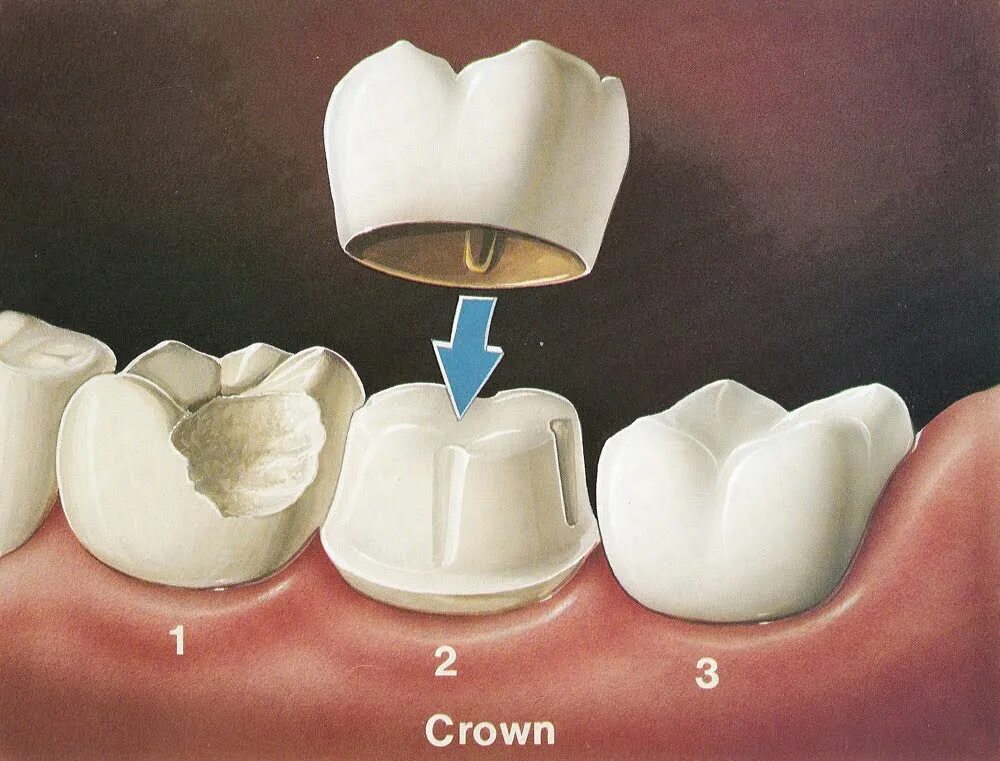 Искусственные коронки. Фарфоровые коронки. Фарфоровая коронка на зуб.