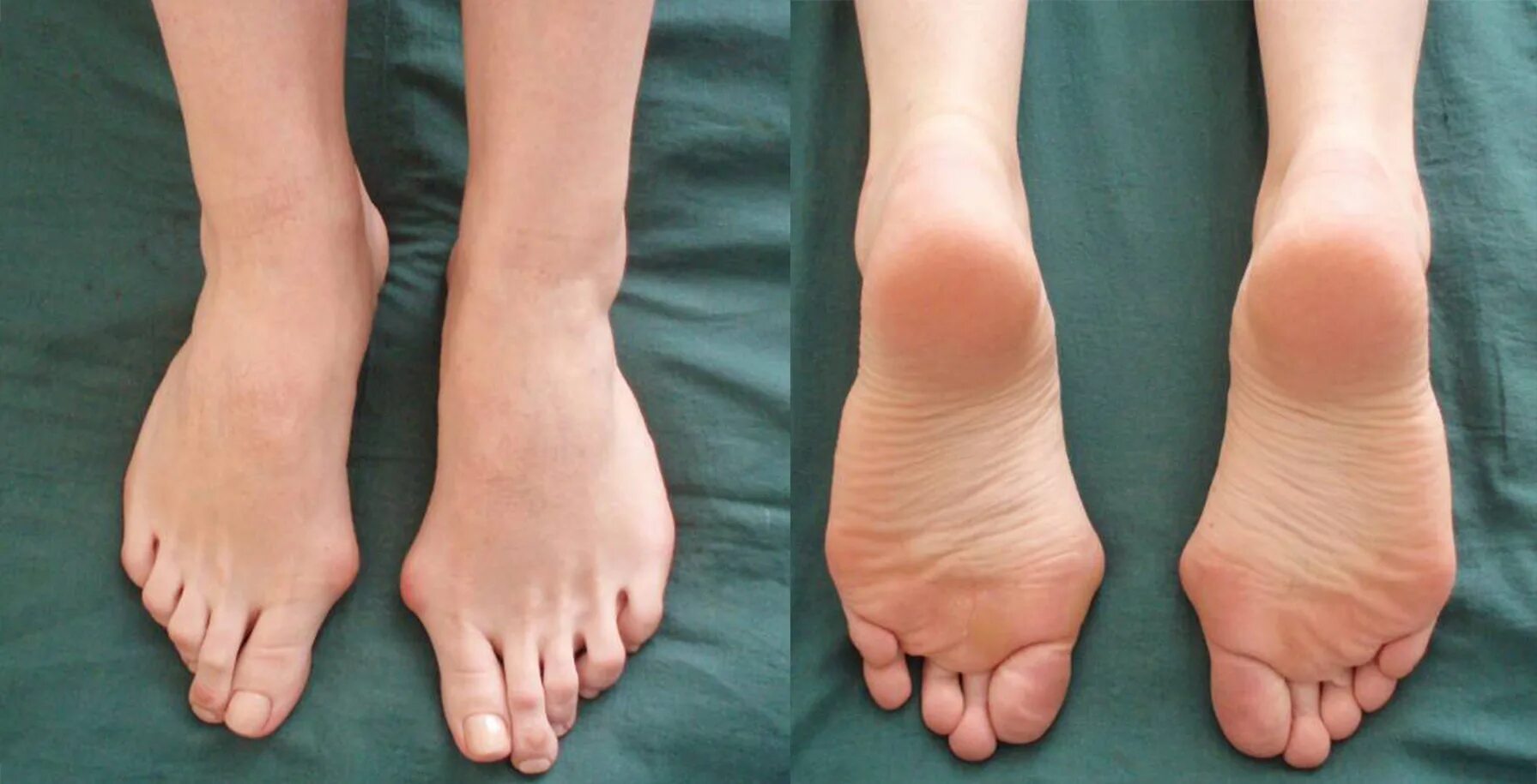 Вальгусная и варусная деформация стопы. Вальгусная и варусная стопа. Исправляем халюс вальгус. Вальгусная деформация и варусная деформация. Варусная деформация коленных суставов.