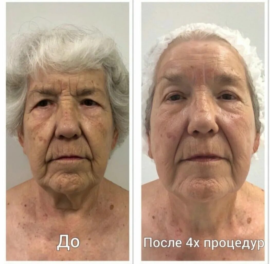Сплит массаж. Сплит массаж лица до и после. сплит массаж для лба. splitmassage. сплит массаж лица видео.