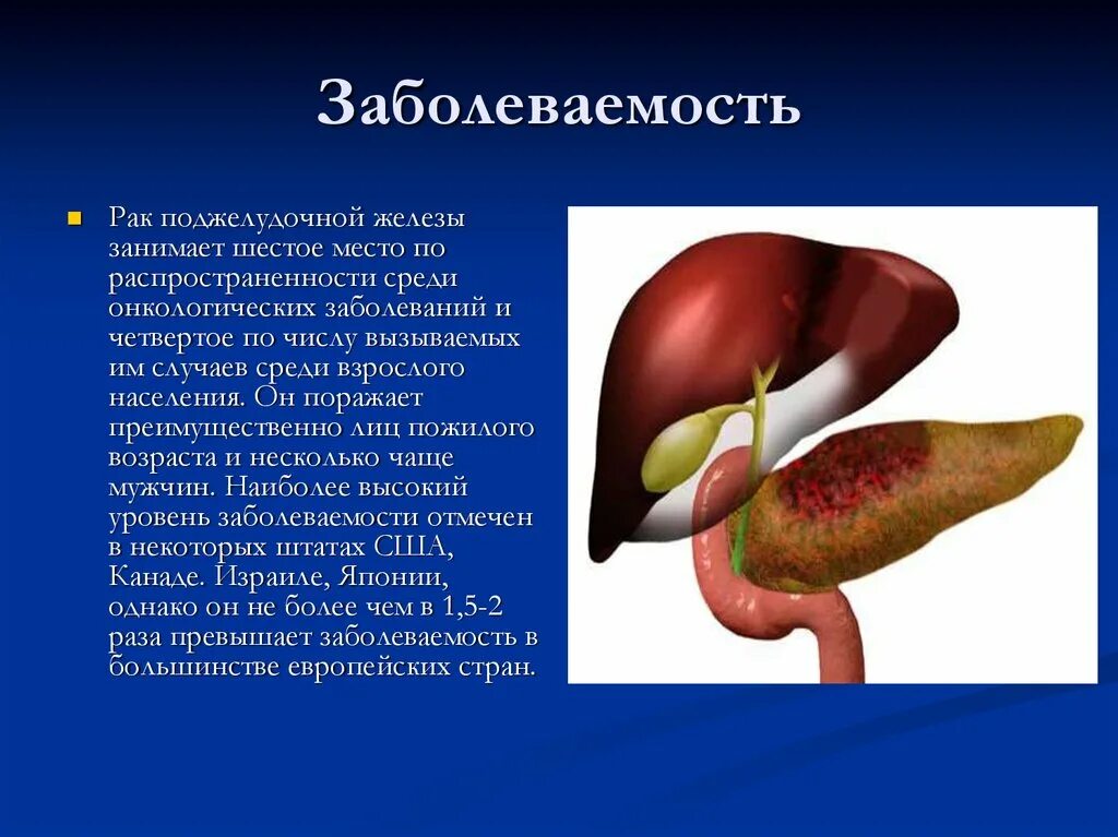 Печень и поджелудочная железа причины. Ракьподжелудочной железы. Опухоль поджелудочной железы. Раковая опухоль поджелудочной железы. Онкология поджелудочной железы.