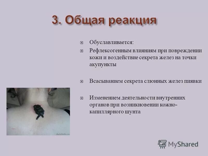 Слюнные железы пиявок содержат. Показания для постановки пиявок. Кольчатые черви пиявки строение. Пищеварительная система медицинской пиявки. Кольчатые черви медицинская пиявка.