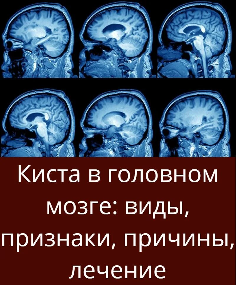 Киста головного мозга причины. Локализация кист головного мозга. Лекарство от кисты головного мозга. Киста в головном мозге у взрослого симптомы.