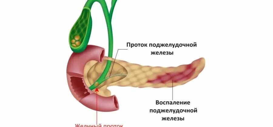 Билиарный острый панкреатит: желчнокаменный панкреатит;. Аномалии протоков поджелудочной железы. Хронический билиарный панкреатит патогенез. Патогенез хронического билиарного панкреатита. Вода в поджелудочной железе