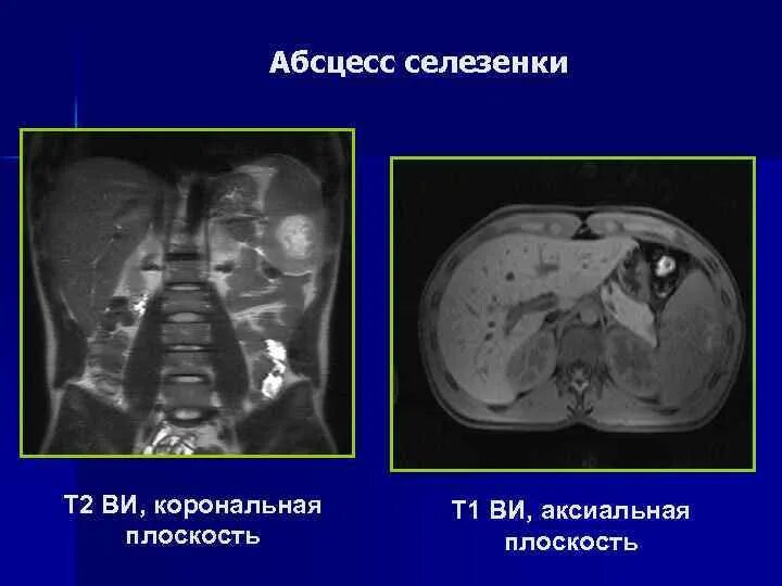 Абсцесс селезенки кт картина. Септическая селезенка кт.