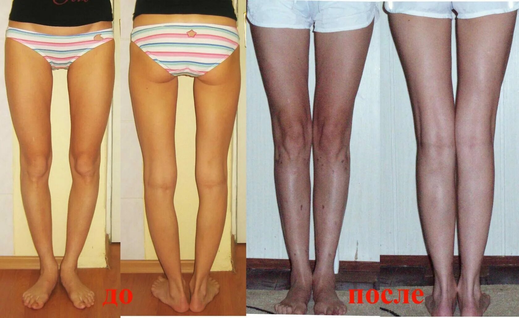 Форма женских ног. Форма ног у женщин. Варусная деформация колена. Какие бывают колени. Какие бывают колени.