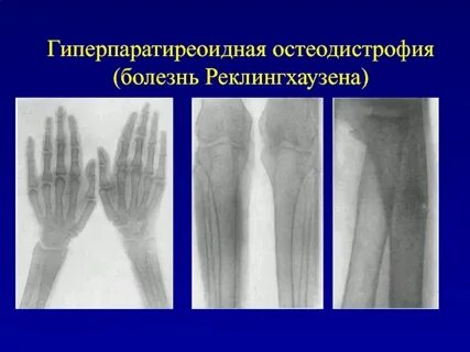 Почечная остеодистрофия