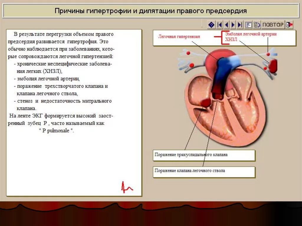 Миокард правого предсердия. Гипертрофия правого предсердия предсердия. Признаком гипертрофии миокарда правого предсердия является. УЗИ сердца гипертрофия правого предсердия. Гипертрофия правых отделов сердца.