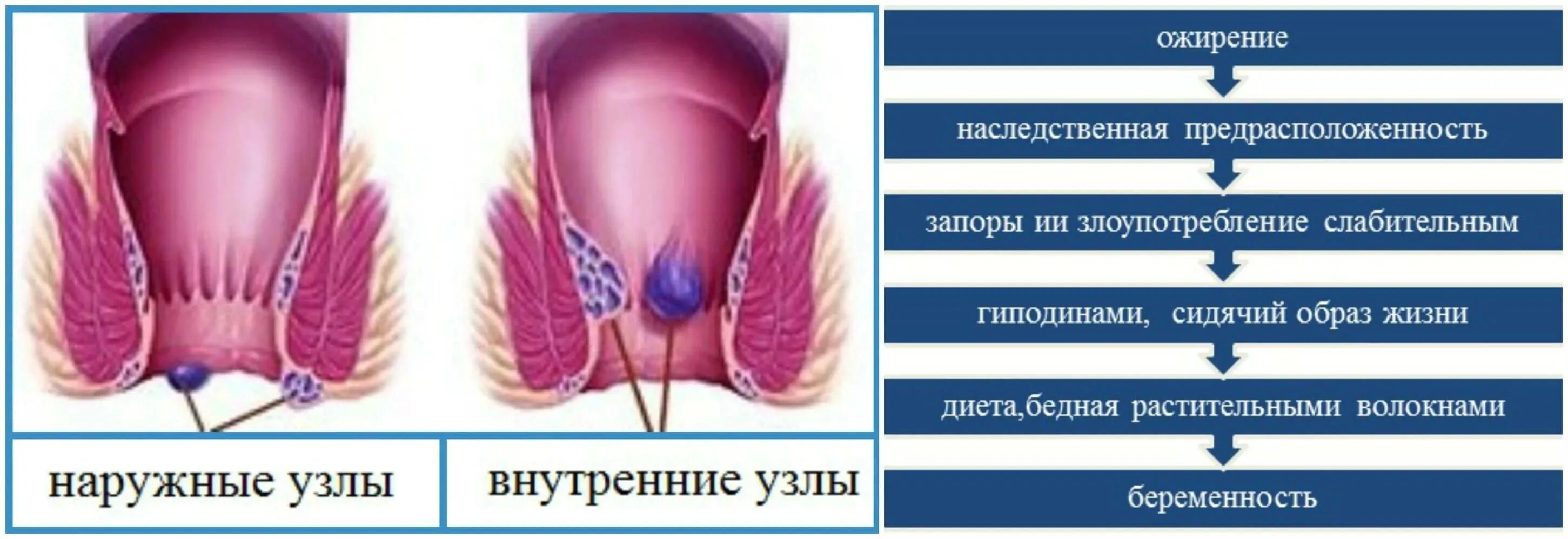 Геморрой причины появления у мужчин лечение. Наружный геморроидальный узел.