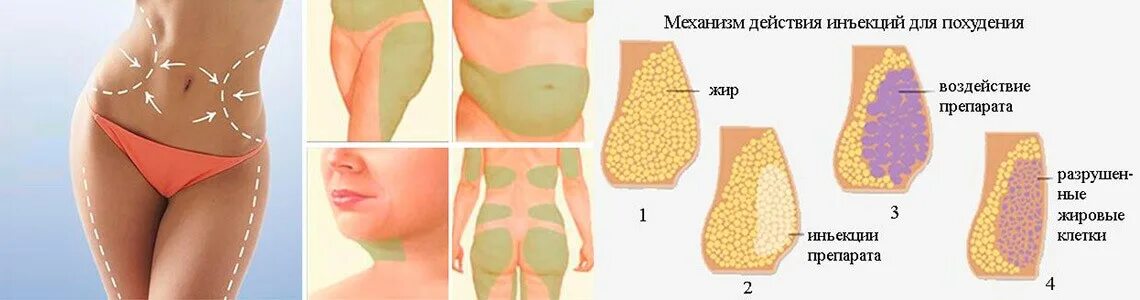 Может ли после уколов. Подкожное Введение липолитиков. Липолитики схема уколов. Схема введения липолитиков в живот. Липолитики в живот схема.