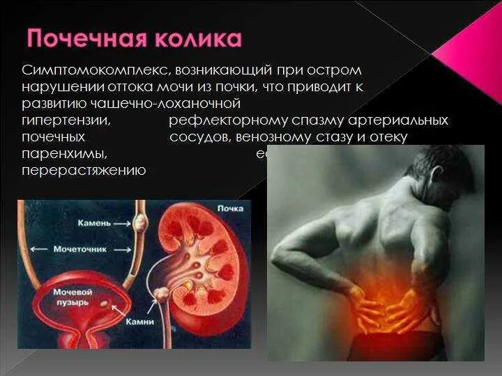 Почечная колика. Приступ почечной колики. Боли в области мочеточника