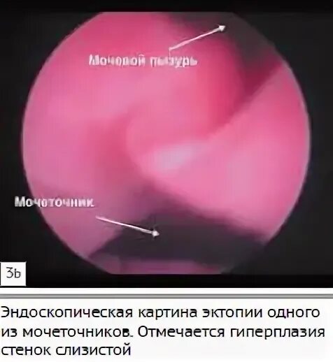 Интрамуральный мочеточник. Интрамуральная эктопия мочеточника. Интрамуральный отдел мочеточника анатомия. Лазерная абляция мочевого пузыря.