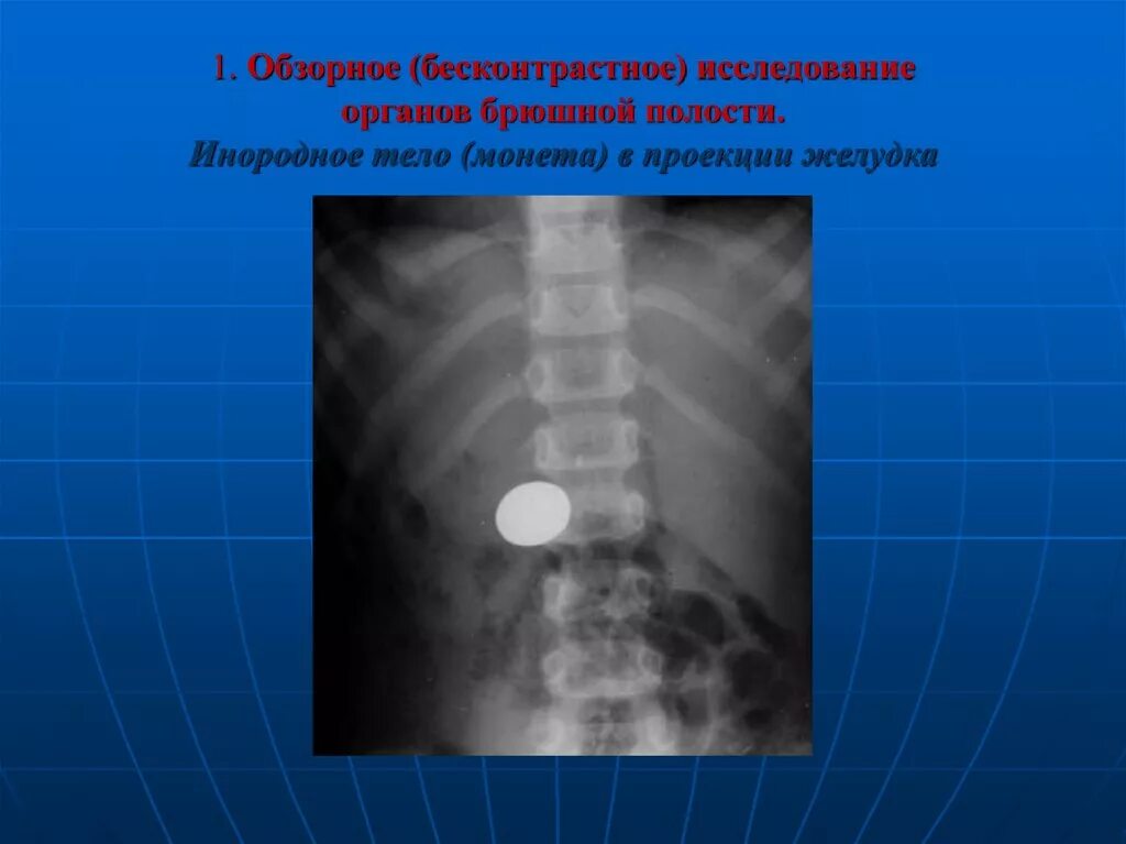 Инородное тело брюшной полости после операции. Обзорный снимок брюшной полости. Обзорная рентгеноскопия органов брюшной полости. Рентгенография обзорный снимок брюшной полости. Обзорная рентгенограмма органов брюшной полости.