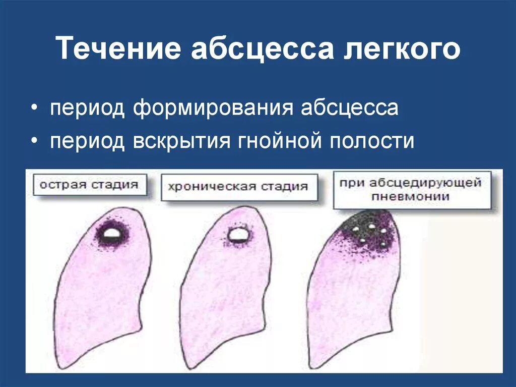 Что такое вскрылась. Фаза формирования абсцесса легкого. Стадии острого абсцесса легкого. Периоды абсцесса легкого. Стадии развития абсцесса легкого.