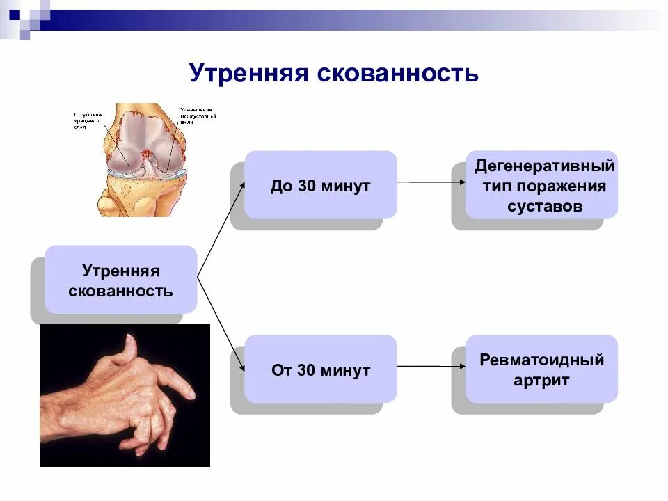 Скованность при ревматоидном артрите. Ревматоидный артрит Утренняя скованность. Утренняя скованность. Утренняя скованность при ревматоидного артрита. Утренняя скованность суставов отмечается.