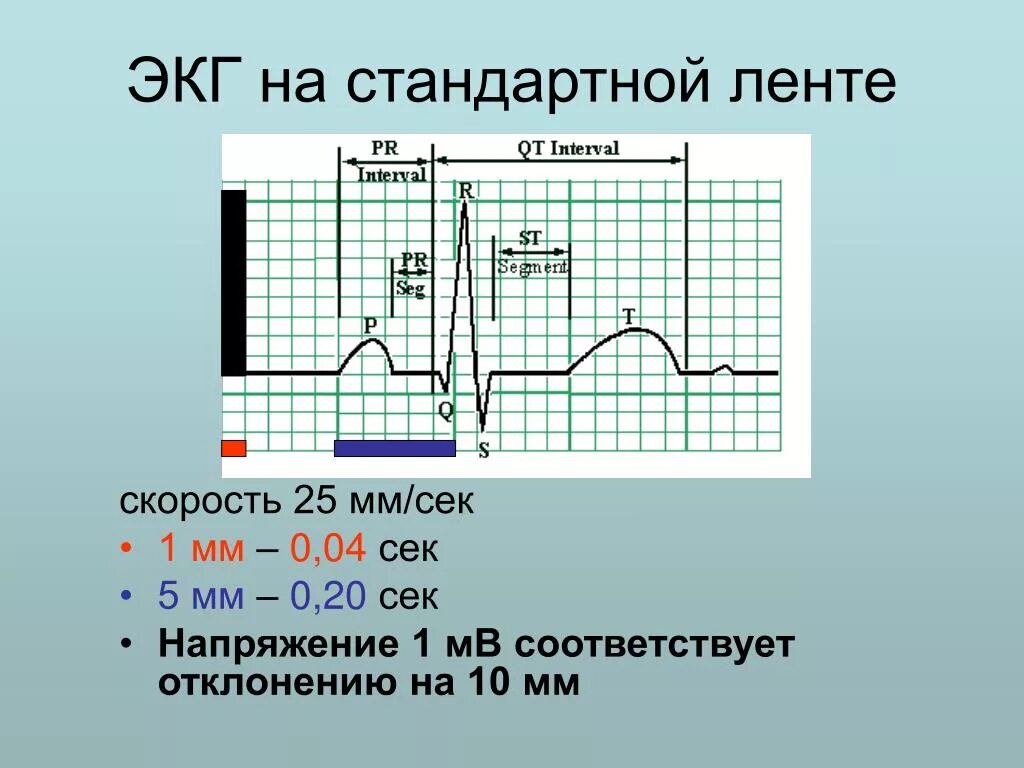 Скорость записи ЭКГ 25 мм с. Скорость записи 50 мм в сек ЭКГ. Вольтаж 50 мм ЭКГ норма. Скорость ленты ЭКГ 50. Экг со скольки