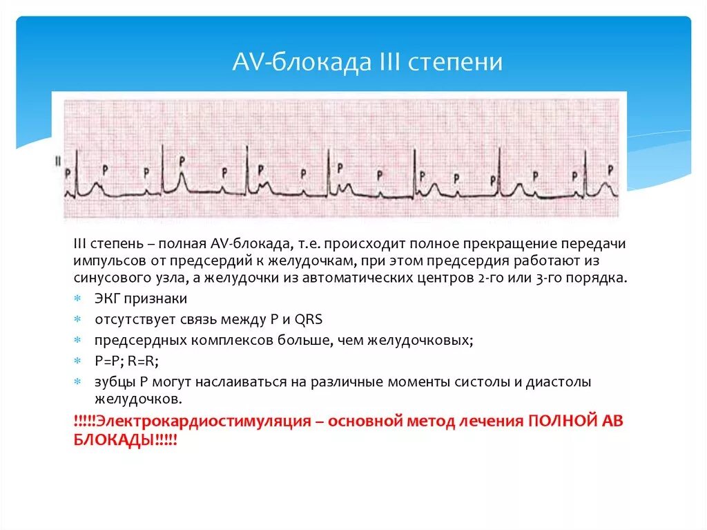 Са блокада 3 степени на ЭКГ. ЭКГ синоатриальной блокады 1 степени. ЭКГ признаки синоатриальной блокады. Блокада синусового узла 2 степени. Са блокада степени