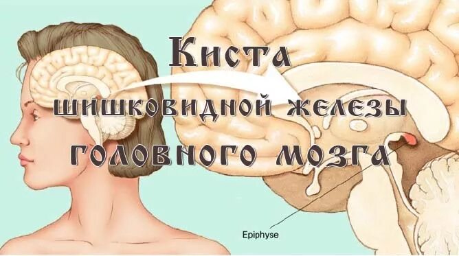 Киста шишковидной железы. Мелкокистозная трансформация шишковидной железы. Киста шишковидной железы симптомы. Поликистоз шишковидной железы