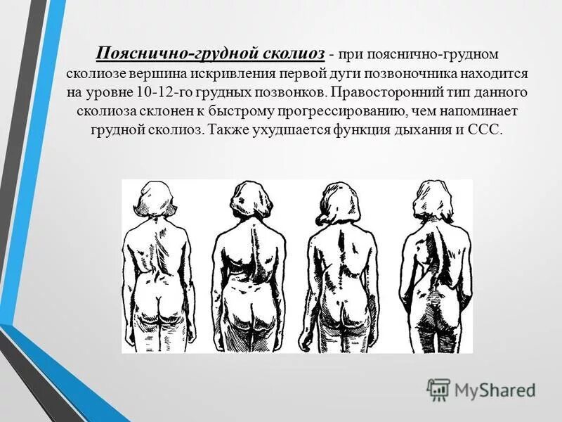 искривление позвоночника вправо. правосторонний сколиоз 1 степени поясничного отдела позвоночника. искривление позвоночника вправо. левосторонний верхнегрудной сколиоз 2 степени. формы искривления сколиоза.