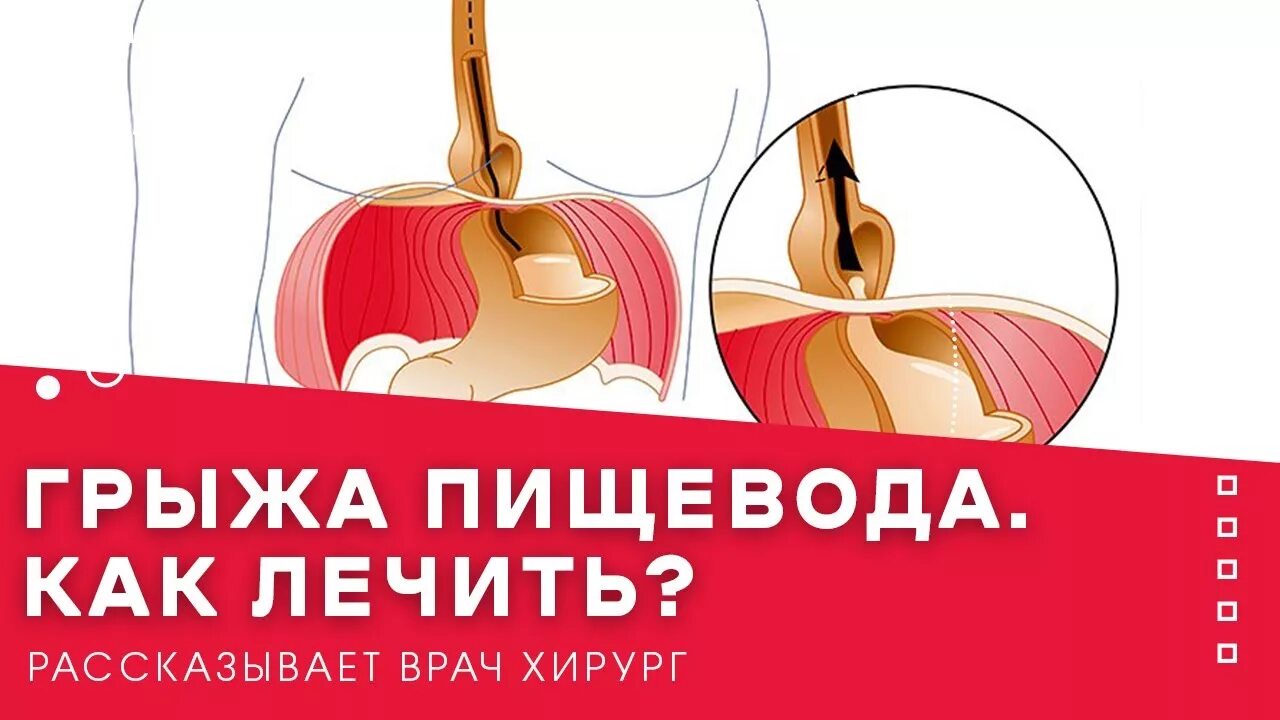 Упражнения для пищевода. Препараты от грыжи пищевода. Лечебная при грыжи пееещеводного отвестия.