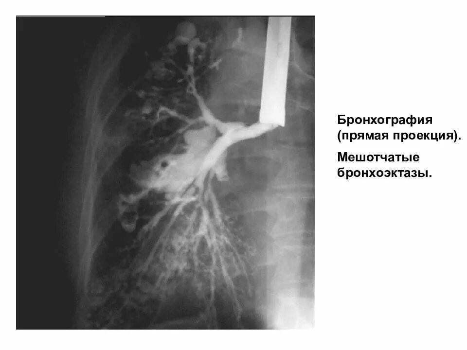 Образование легких неуточненное