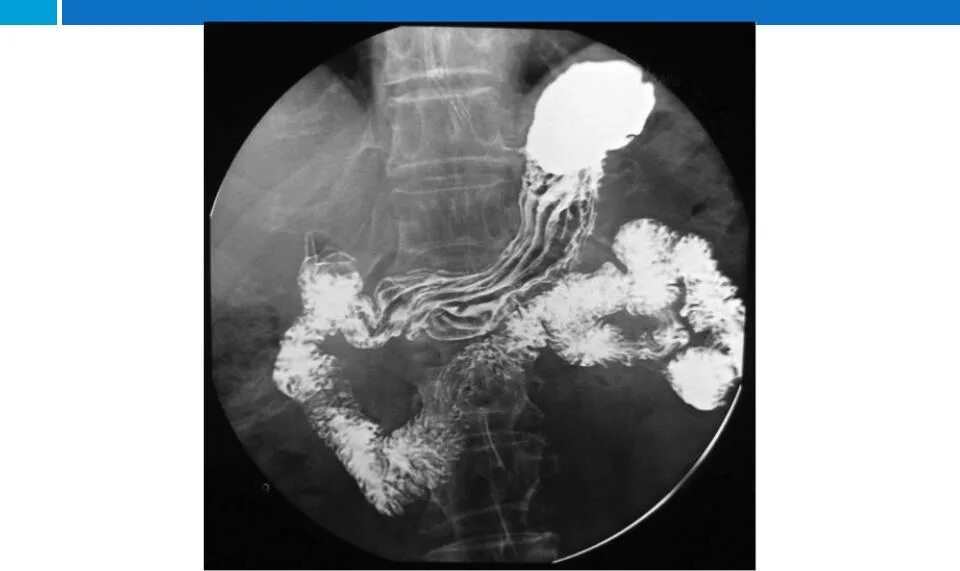 Пищевода с барием. Двойное контрастирование желудка рентген. Рентген исследования желудка и 12 перстной кишки. Контрастирование желудка и 12-перстной кишки рентген.