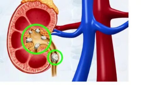 Vuani nga gurët në veshka, ushqimet që duhet të konsumoni dhe ato që duhet t’i s