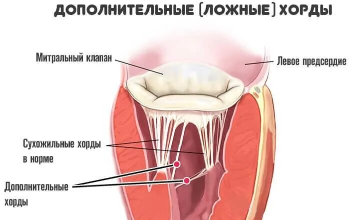 Наличие хорды у человека. Дополнительная хорда в левом желудочке сердца. Дополнительная поперечная хорда левого желудочка. Избыточная хорда митрального клапана. Ложные хорды митрального клапана.