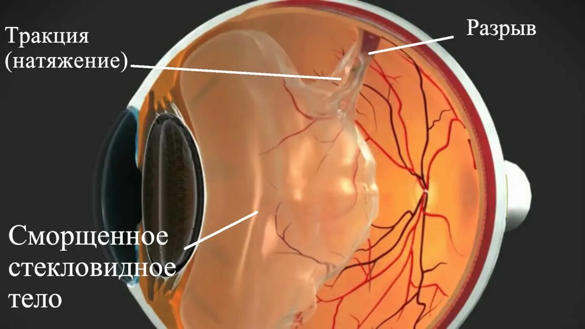 Тракционная отслойка сетчатки глаза. Глазное дно отслоение сетчатки. Тракция стекловидного тела на сетчатку.
