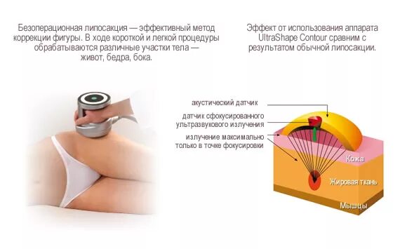 Кавитация аппарат отзывы. Безоперационная ультразвуковая липосакция. Безоперационная липосакция на аппарате это. Методы безоперационной липосакции.