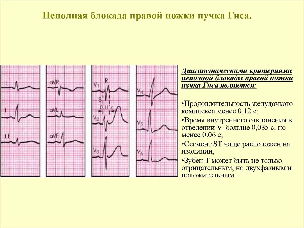 Блокада правого желудочка. Блокада ножки пучка Гиса на ЭКГ. Блокада левой ножки пучка Гиса на ЭКГ. Блокада правой ножки пучка Гиса на ЭКГ. Блокада правой ножки ПГ на ЭКГ.