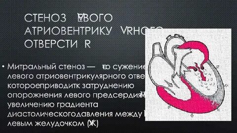 Атриовентрикулярный стеноз