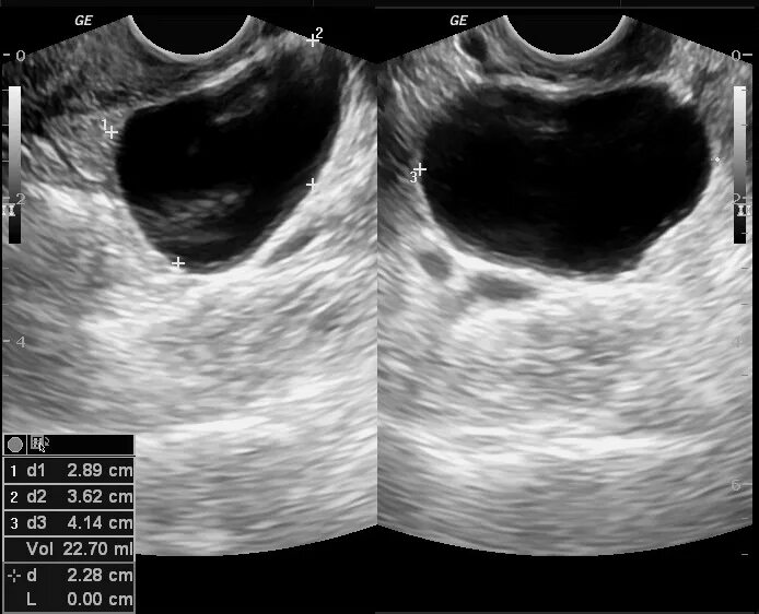 Фолликулярная киста яичника на УЗИ. Параовариальная киста яичника. Параовариальная киста на УЗИ. Многокамерная киста яичника на УЗИ.