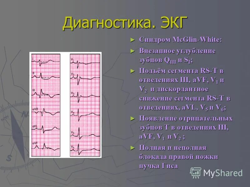 Тромбоэмболия легочной артерии экг