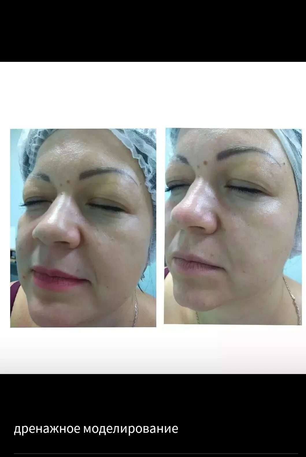 Дренажное моделирование. Дренажное моделирование для лица v-lift. Дренажное моделирование. Аравия профессиональная косметика. Криолифтинг лица фото.