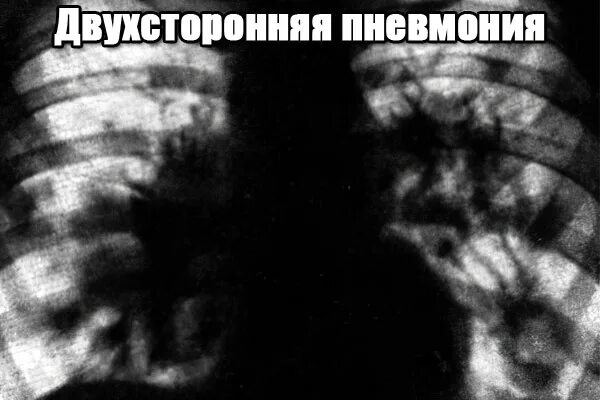 Пневмония воспаление легких. Возможные осложнения пневмонии. Осложнения острой пневмонии. Ковидная пневмония снимок. Последствие двухсторонней пневмонии.