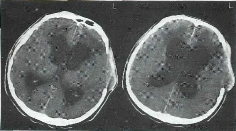 Операция гидроцефалия мозга. Гидроцефалия головного мозга мрт. Окклюзионная гидроцефалия. Арезорбтивная гидроцефалия головного мозга. Гидроцефалия головного мозга у взрослого на кт.