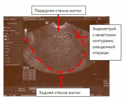 Стенки матки на узи