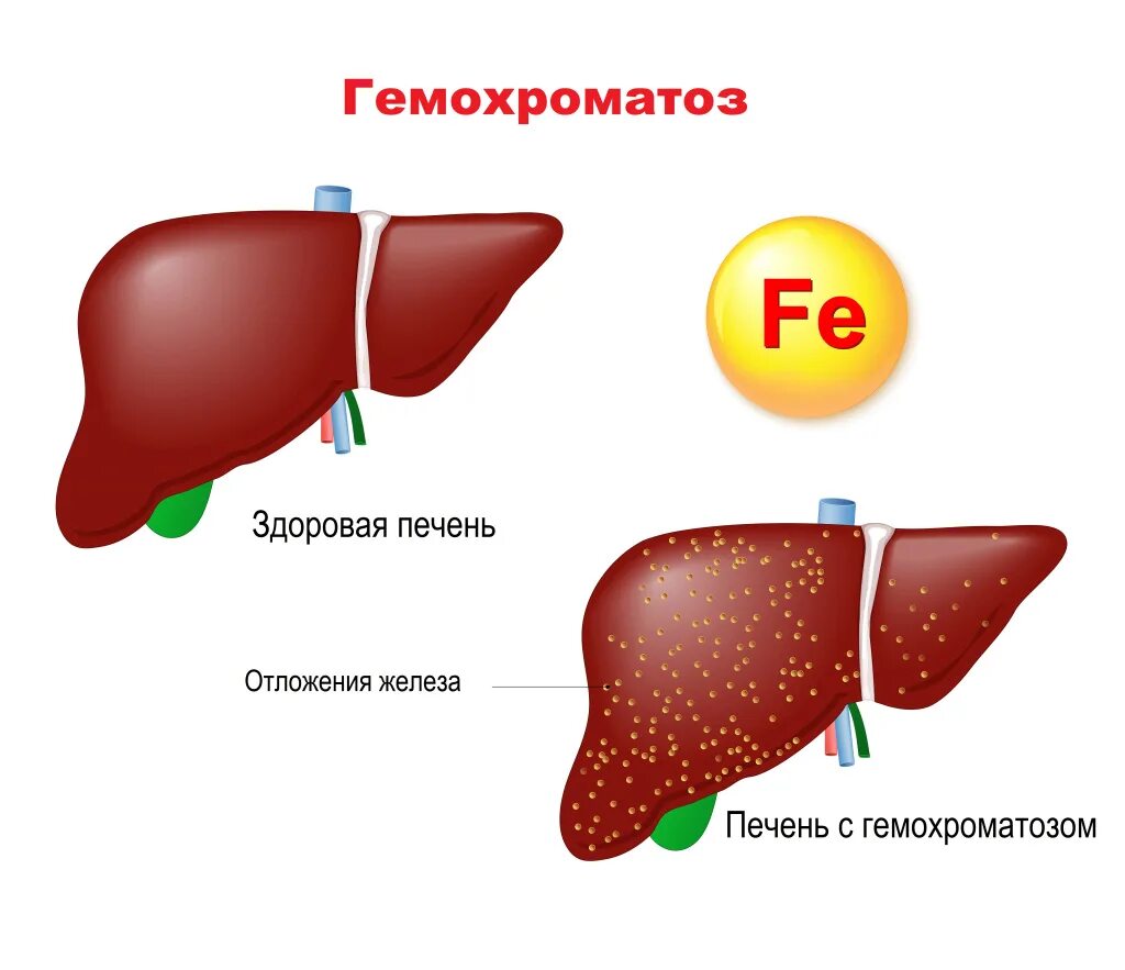 Печень и железо в крови. Г4мвхромотоз.