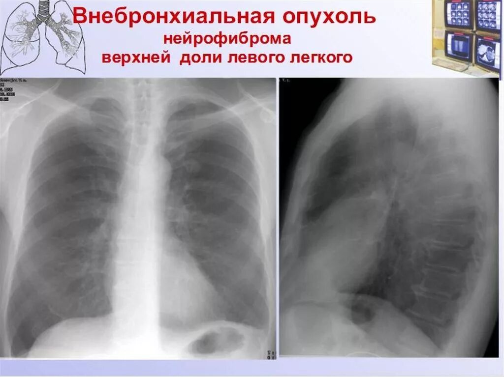 Саркома легкого рентген. Периферическое образование легкого. Саркома легкого рентген. Периферическое образование в правом легком. Периферическая опухоль верхней доли правого легкого кт.