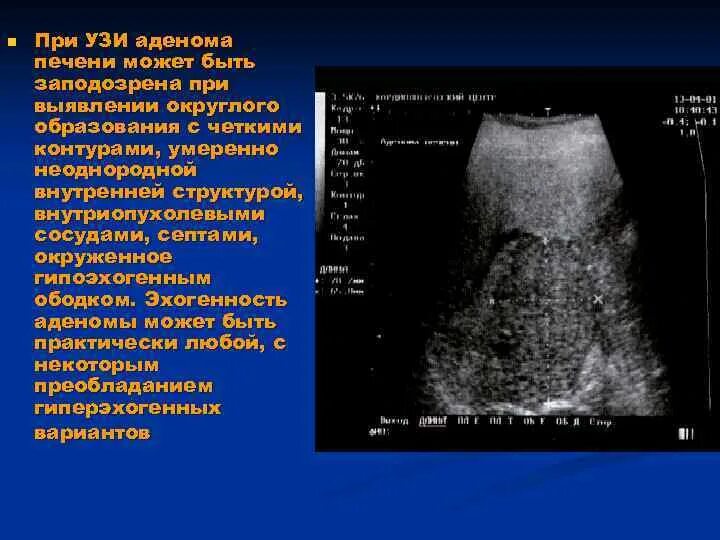 Образования печени по УЗИ. Очаговая гиперплазия печени на УЗИ.