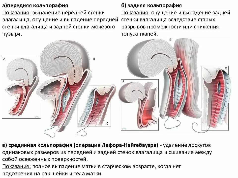 Операция по подтяжке матки. Задняя и передняя кольпорафия операция. Кольпорафия передней стенки. Опущение задней стенки.