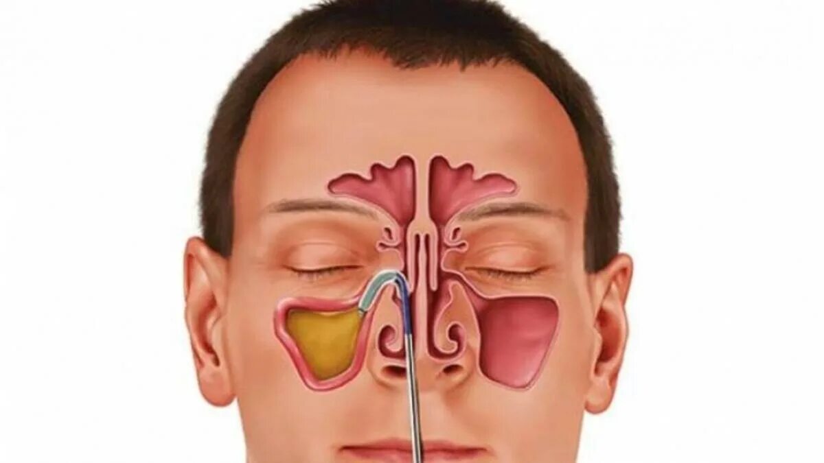 Синусит верхнечелюстной пазухи. Гайморит верхнечелюстной пазухи. Этмоидит сфеноидит фронтит. Пазухи носа анатомия синусит. Двухсторонний гнойный