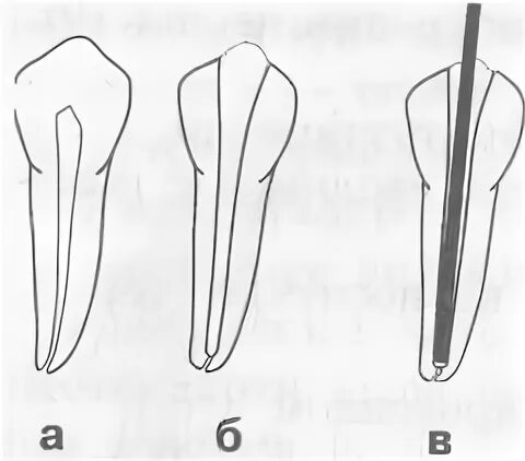 Обработка корневых каналов техники. Стандартизованная техника обработки корневого канала. Инструментальная обработка корневых каналов. Стандартная техника обработки корневых каналов. Коническая форма канала.