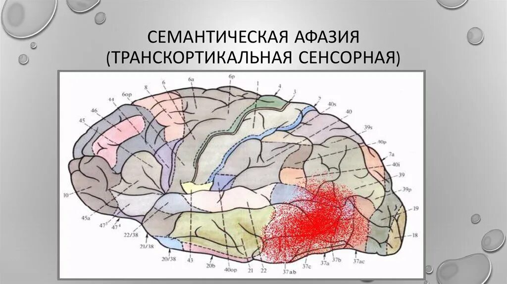 Акустико семантической афазии